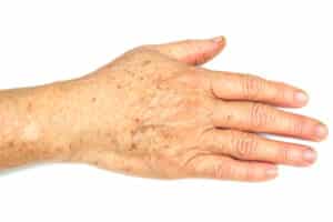 essential tremor