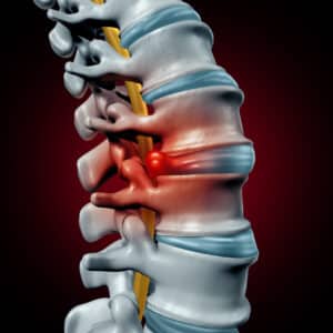 disc herniation dallas tx