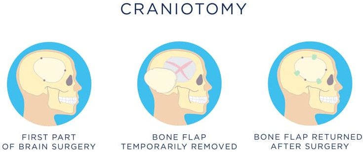 Craniotomy procedure illustration